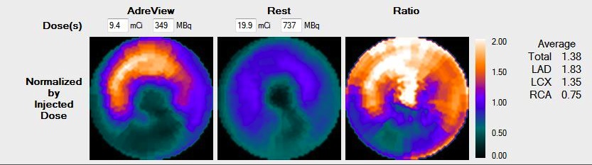 AdreView polar map ratios from injected dose