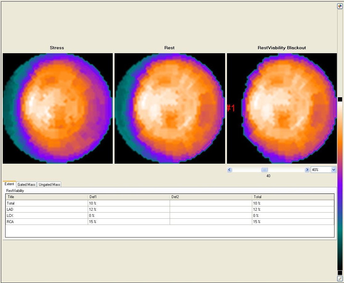 polar maps and estimated LV viability